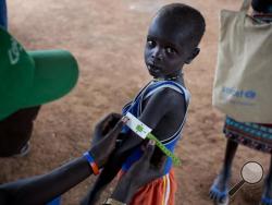 In this photo taken Thursday, Oct. 20, 2016 and released by UNICEF, a boy has his arm measured to see if he is suffering from malnutrition during a nutritional assessment at an emergency medical facility supported by UNICEF in Kuach, on the road to Leer, in South Sudan. Famine has been declared Monday, Feb. 20, 2017 in two counties of South Sudan, according to an announcement by the South Sudan government and three U.N. agencies, which says the calamity is the result of prolonged civil war and an entrenched