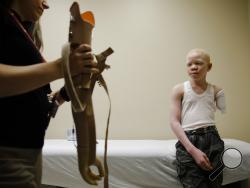  Jennifer Stieber brings in Mwigulu Matonange's prosthetic limb during a fitting at Shriners Hospital for Children in Philadelphia, Tuesday, May 30, 2017. Cosmas, an albino from Tanzania was on a return trip to the United States to be refitted for a new prosthetic. Albinos in traditional communities in Tanzania are hunted for their limbs which attackers believe hold magical power. (AP Photo/Matt Rourke)