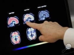 Dr. William Burke goes over a PET brain scan Tuesday, Aug. 14, 2018 at Banner Alzheimers Institute in Phoenix. It may be too late to stop Alzheimer's in people who already have some mental decline but Banner is conducting two studies that target the very earliest brain changes while memory and thinking skills are still intact in hope of preventing the disease. (AP Photo/Matt York)