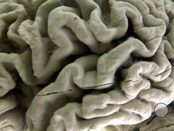 FILE - A closeup of a human brain affected by Alzheimer's disease, is displayed at the Museum of Neuroanatomy at the University at Buffalo in Buffalo, N.Y., on Oct. 7, 2003. According to findings published Wednesday, Feb. 21, 2024 in the New England Journal of Medicine, Alzheimer’s quietly ravages the brain long before symptoms appear and now scientists are getting a closer look at the domino-like sequence of those changes _ a potential window to one day intervene. (AP Photo/David Duprey)