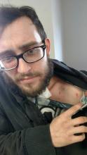 Josh Lahr, 24, shows the wound left in his shoulder by a bullet that went in his face, next to his nose, through his right cheekbone and into the shoulder. (Press Enterprise/Leon Bogdan)